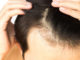 Sintomi e conseguenze dell’alopecia androgenetica: come affrontarla